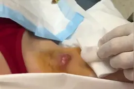 医生处理胳肢窝长里的大囊肿，挤出清理完毕后再也不难受了。视频封面