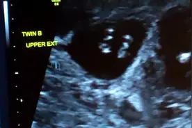 12周超声实拍：婴儿的心跳，拇指吸吮和小小的脚视频封面