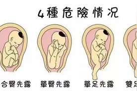 高清动图详解胎儿臀位生产全过程！胎儿臀位想顺产的先看看吧！图片