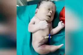 印度再现一例美人鱼宝宝，双腿粘连没有脚，医生惊呼没见过！视频封面