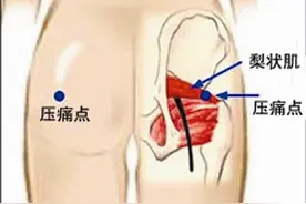 久坐屁股痛（梨状肌综合症），最好的锻炼方法。图片