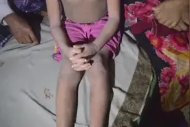 那个身体长满灰色鳞片的孟加拉国男孩 奇迹康复视频封面