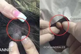 医生划开20年的痘痘 让人惊悚：竟然挤出豌豆大小的白色囊肿图片