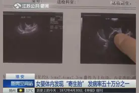 女婴体内发现“寄生胎” 发病率五十万分之一图片