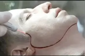 这个整容技术真高，直接整张脸切下来换，为了破案也是拼了