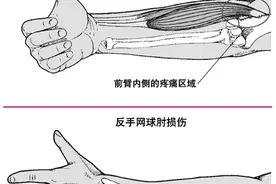 诱发网球肘的原因有哪些图片