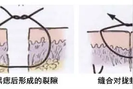卢丙仑教授：黑痣切除后会留下“坑”吗?图片