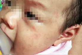 专家在线丨宝宝一着急就容易出红疹？那肯定是没处理好这些问题！图片