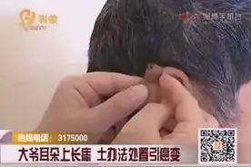 大爷耳朵上长痣 土办法处置引癌变视频封面