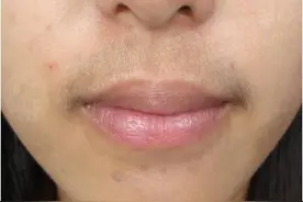 3次冰点脱唇毛后，小胡子没有了图片