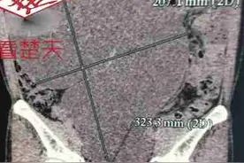 男子腹部隆起似足月孕妇，原是体内“第三个肾”严重积水了图片