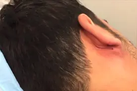 医生处理一个耳垂下方巨大的囊肿，挤出来以后舒服多了！视频封面