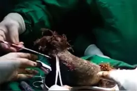 女孩偷吃自己头发5年 产生异食症的原因是什么图片