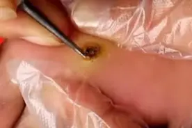 脚底长个大“鸡眼”疼痛难忍，医生帮他刮掉后，感觉舒畅多了