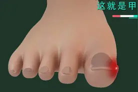 甲沟炎是怎么形成的？3D演示过程，剪指甲也要小心呀视频封面