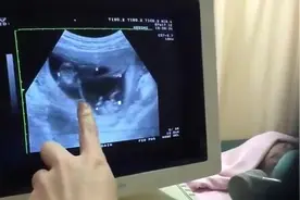 “四进宫”试管婴儿，竟是四胞胎！B超时的画面好神奇！图片