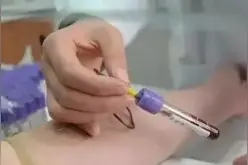 静脉抽血如何防止淤青图片