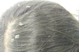 头皮屑大块能扣下来怎么办？有什么好的治疗方法吗？