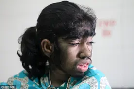 现实中真有狼人？孟加拉国女孩患狼人综合症，身上长满浓黑毛发图片