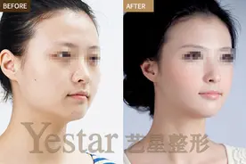 开外眼角手术是怎么进行的图片