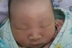 带你了解新生儿黄疸图片