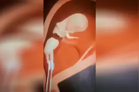 中国一年有1300万人做人流手术，医生都是这样给孕妇做刮宫手术的视频封面