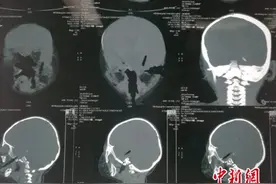 惊险！男童边走边玩摔倒后筷子插入颅内4厘米(图)图片