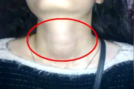 缺碘会患大脖子病，另外这3个原因，你可别放松警惕视频封面