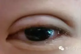 双眼皮手术半年了，又肿又宽，多久才恢复图片