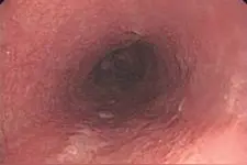 “化整为零”的黏膜切除术——内镜分片黏膜切除术图片