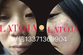 微商怎么加入涵曦做代理，涵曦LATOJA排毒针效果图片