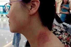 神经性皮炎及其防治图片