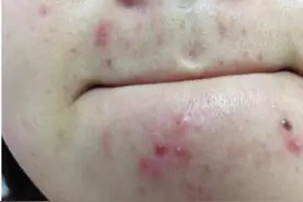 下巴长痘痘隐藏的六大原因是什么？怎么调理呢？图片