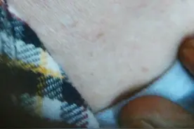 手上长出“黑痣”要小心，说不定要命！图片