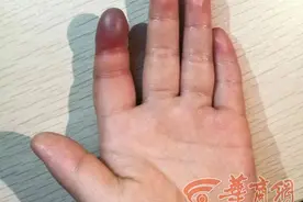 家长注意！西安4岁女童皮筋套手指睡着 手指缺血性坏死差点截肢图片
