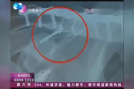 手术做完了钻头断裂在身体里 院方回应:这很正常 给你免费取出图片