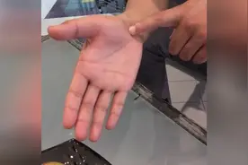筋缩百病起，筋柔百病消,简单的方法解决腕管综合征，鼠标手视频封面