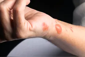 皮肤烫伤怎么办图片