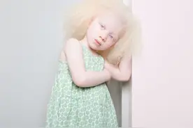 摄影师捕捉白化症孩子的另类之美图片