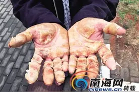 海口一农民工油漆“中毒”至双手皲裂 有关部门建议做工伤鉴定图片