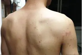 小伙一觉醒来浑身疙瘩 凶手竟是凉席图片