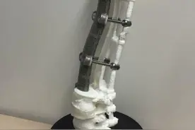 世界首个3D打印人工椎体植入获得成功图片