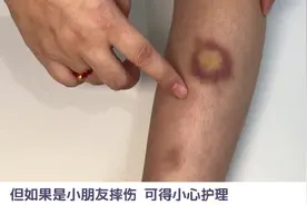 不小心打到胳膊腿怎么办？乡下常用的两个土方法，快速消肿去淤青