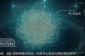 「3D演示」阿尔兹海默病(Alzheimer's disease, AD)视频封面