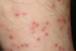 夏夜  树上掉下一条狰狞的小黑虫  花季女孩竟差点丧命！图片