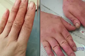 用醋泡生鸡蛋可以治湿疹？专家：湿疹患者应该注意这几点视频封面