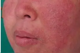 红血丝能根治吗 教你击败红血丝的5种方法！图片