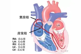 心跳乱了，原来是早搏在“作祟”，揭秘这种最常见的心律失常图片