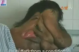 超级恐怖的畸形大象脸人！重口味慎入！视频封面