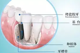 牙齿种植术后该如何护理图片